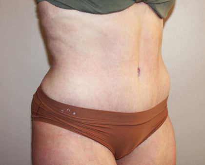 Tummy Tuck Before & After Patient #3027