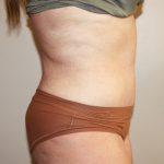 Tummy Tuck Before & After Patient #3027