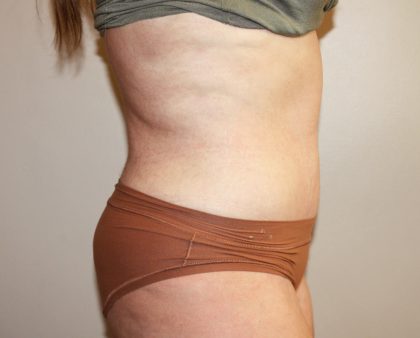 Tummy Tuck Before & After Patient #3027