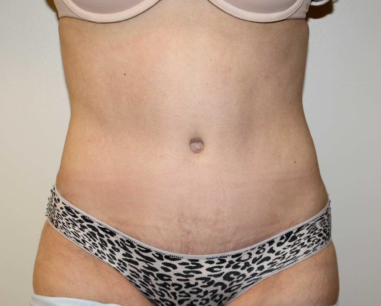 Tummy Tuck Before & After Patient #2963
