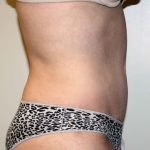 Liposuction Before & After Patient #2963