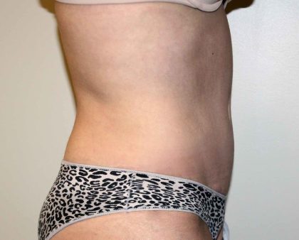 Liposuction Before & After Patient #2963