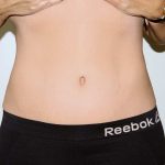 Tummy Tuck Before & After Patient #2878