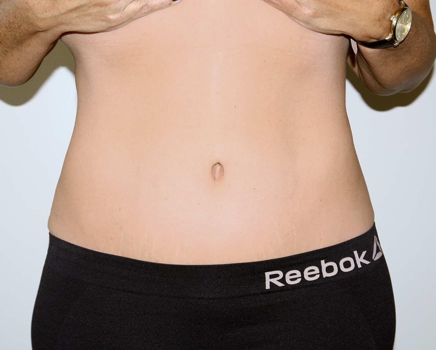 Major Weight Loss Tummy Tuck Before & After Patient #2878