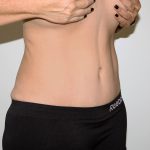 Tummy Tuck Before & After Patient #2878