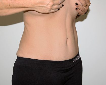 Tummy Tuck Before & After Patient #2878