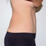 Tummy Tuck Before & After Patient #2878