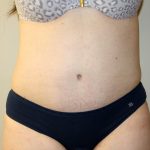 Tummy Tuck Before & After Patient #2864