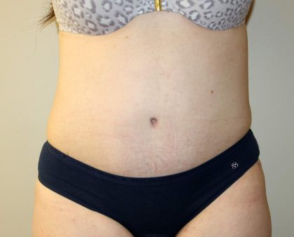 Tummy Tuck Before & After Patient #2864