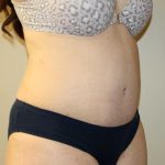 Tummy Tuck Before & After Patient #2864