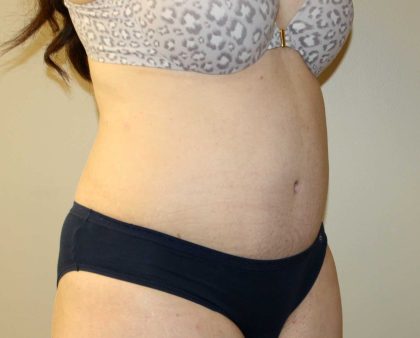 Tummy Tuck Before & After Patient #2864