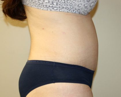 Tummy Tuck Before & After Patient #2864