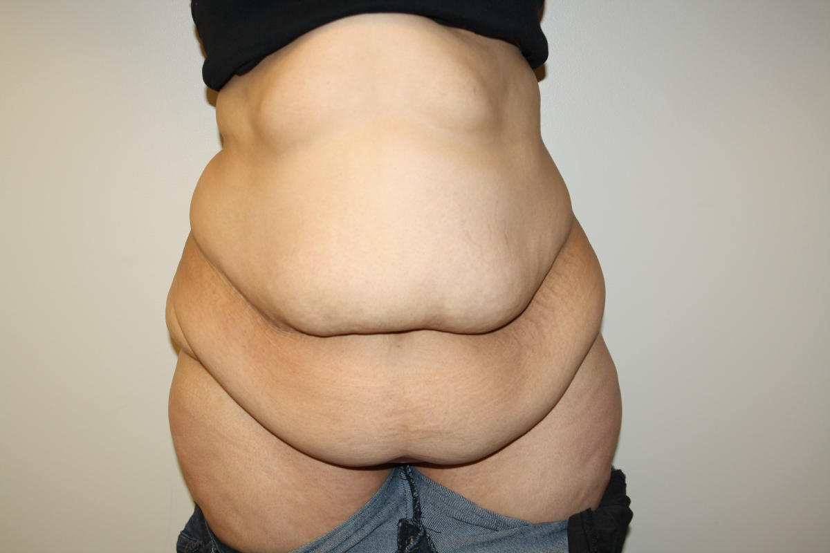 Major Weight Loss Tummy Tuck Before & After Patient #3007