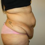 Tummy Tuck Before & After Patient #3007