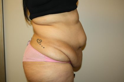 Tummy Tuck Before & After Patient #3007