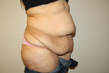 Tummy Tuck Before & After Patient #3007