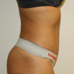 Tummy Tuck Before & After Patient #3034