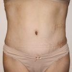 Tummy Tuck Before & After Patient #2956