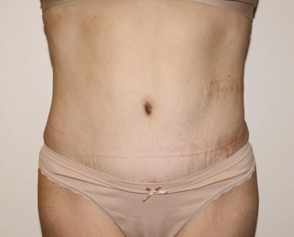 Tummy Tuck Before & After Patient #2956