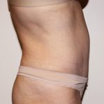 Tummy Tuck Before & After Patient #2956