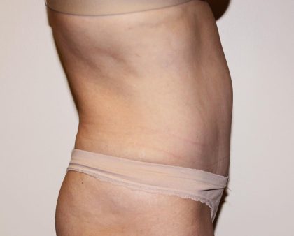 Tummy Tuck Before & After Patient #2956