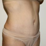 Tummy Tuck Before & After Patient #2956