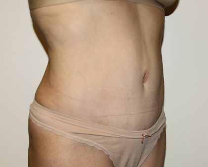 Tummy Tuck Before & After Patient #2956