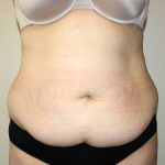 Tummy Tuck Before & After Patient #2913