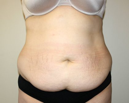 Tummy Tuck Before & After Patient #2913