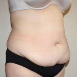 Tummy Tuck Before & After Patient #2913