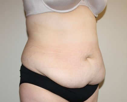 Tummy Tuck Before & After Patient #2913