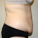 Tummy Tuck Before & After Patient #2913