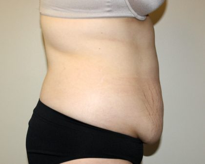 Tummy Tuck Before & After Patient #2913