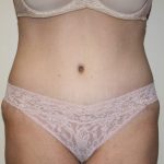 Tummy Tuck Before & After Patient #2906