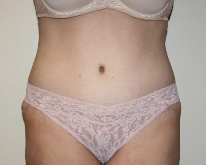 Tummy Tuck Before & After Patient #2906