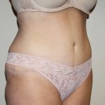 Tummy Tuck Before & After Patient #2906