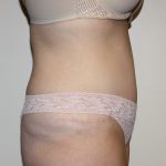 Tummy Tuck Before & After Patient #2906
