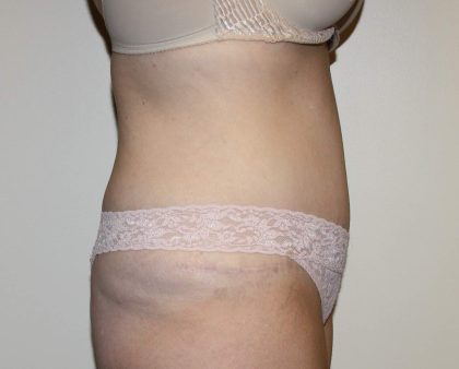 Tummy Tuck Before & After Patient #2906