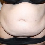 Tummy Tuck Before & After Patient #2942