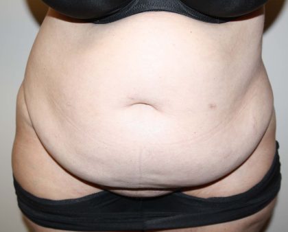 Tummy Tuck Before & After Patient #2942