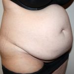 Tummy Tuck Before & After Patient #2942