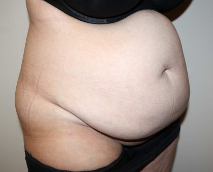 Tummy Tuck Before & After Patient #2942