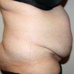 Tummy Tuck Before & After Patient #2942