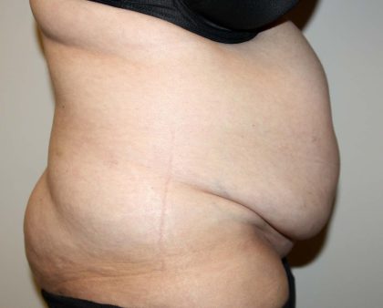 Tummy Tuck Before & After Patient #2942