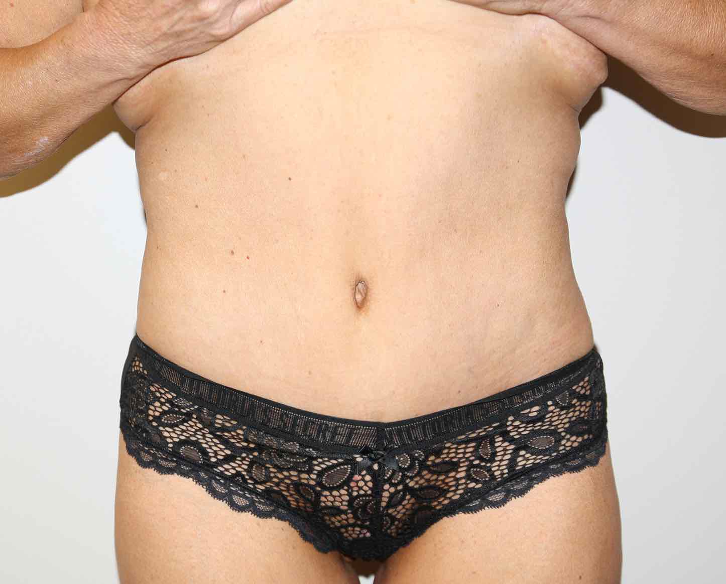 Major Weight Loss Tummy Tuck Before & After Patient #2970