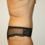 Tummy Tuck Before & After Patient #2970