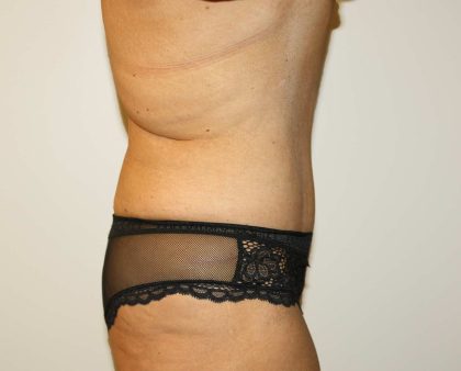 Tummy Tuck Before & After Patient #2970