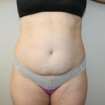 Tummy Tuck Before & After Patient #3020