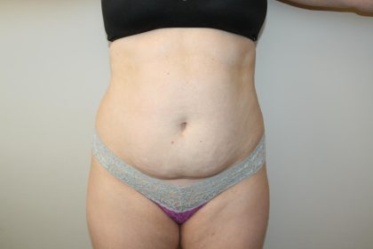 Tummy Tuck Before & After Patient #3020