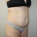 Tummy Tuck Before & After Patient #3020